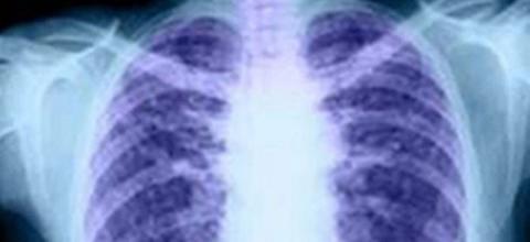 πνευμονίας_ΑΜΝΑ